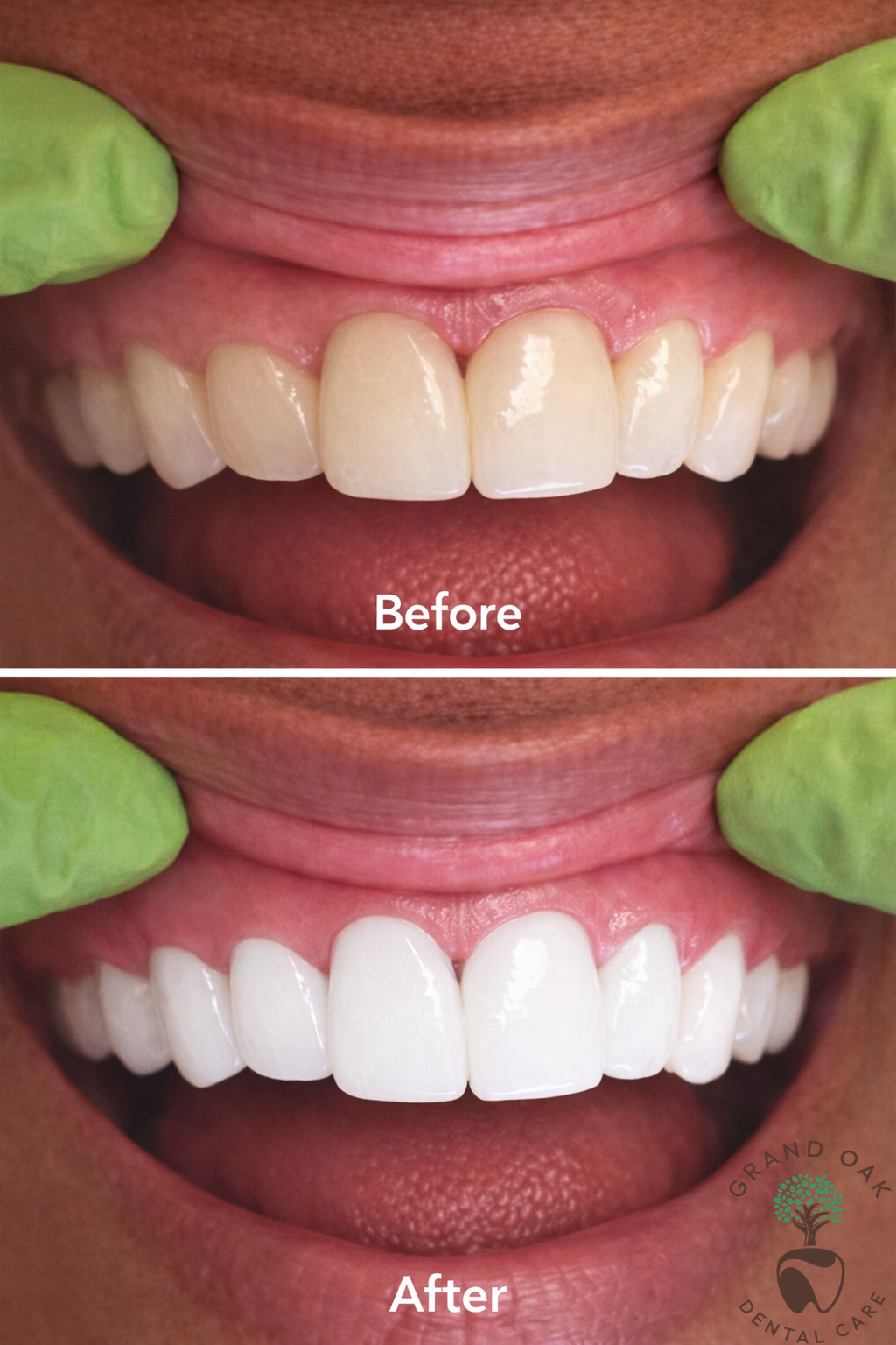 In-House Bleaching Results